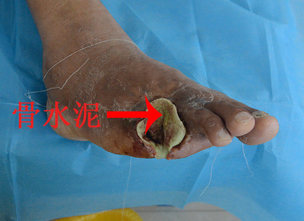 截趾后伤口用骨水泥覆盖治疗无效的案例!