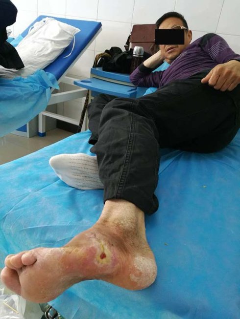 糖尿病严重的并发症足病烂脚一直治不好什么原因?