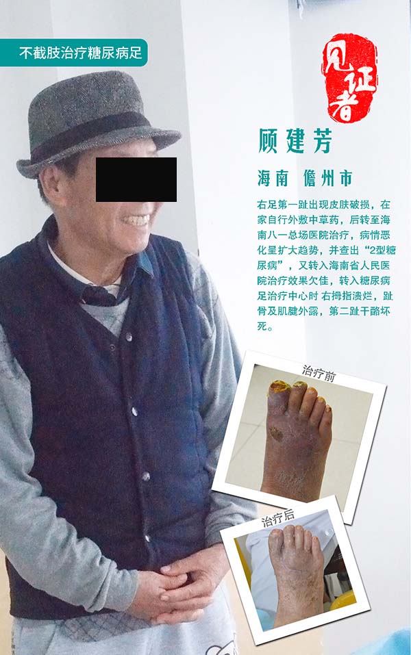 袁敏琴:糖尿病足真的可以保守治疗不截肢吗?真的可以相信吗?