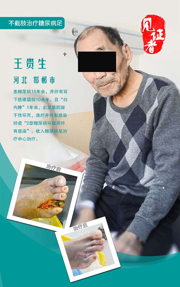 袁敏琴:糖尿病足真的可以保守治疗不截肢吗?真的可以相信吗?