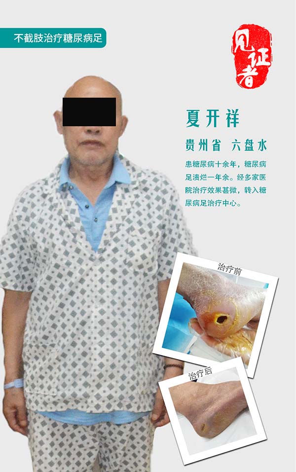袁敏琴:糖尿病足真的可以保守治疗不截肢吗?真的可以相信吗?