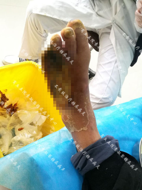 糖尿病脚发黑发干坏死怎么治疗?可以不截肢吗?