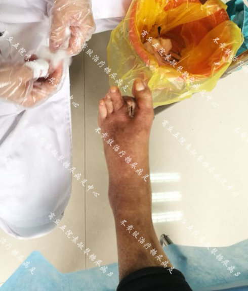 糖尿病脚发黑发干坏死怎么治疗?可以不截肢吗?