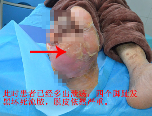 糖尿病患者脚部脱皮是不是糖尿病足的早期症状?怎么治疗呢?