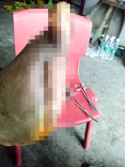 糖尿病患者脚部脱皮是不是糖尿病足的早期症状?怎么治疗呢?