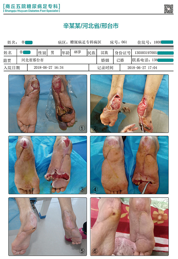 袁敏琴:为什么糖尿病患者的皮肤容易感染出现糖尿病足?