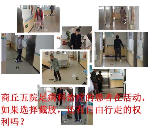 糖尿病人的脚被扎上会变成糖尿病足而截肢吗