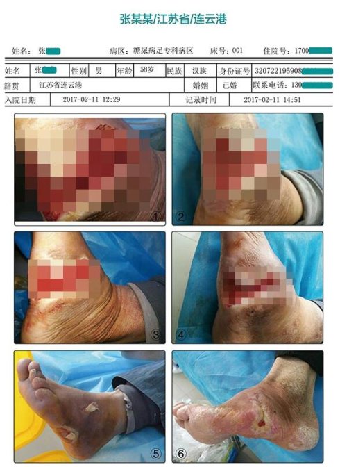 导致糖尿病足患者从小伤到截肢什么原因?