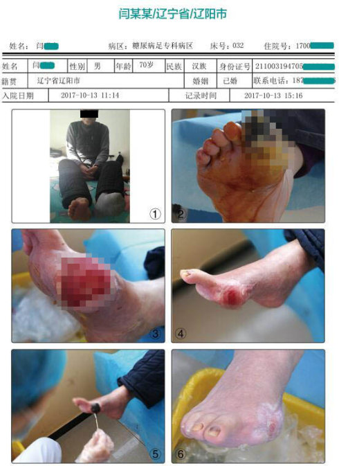导致糖尿病足患者从小伤到截肢什么原因?
