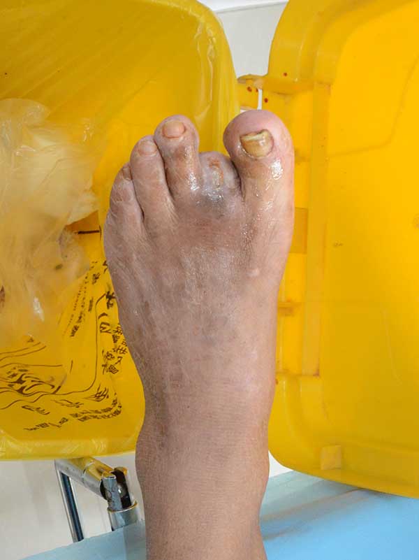 江苏糖尿病足下肢动脉闭塞脚趾发黑坏死的保守不截肢治疗案例