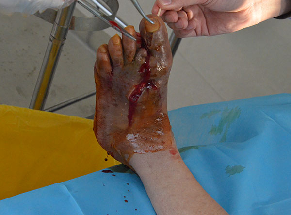 甘肃糖尿病烂脚患者做过截趾和负压引流无效后的保守不截肢治疗案例