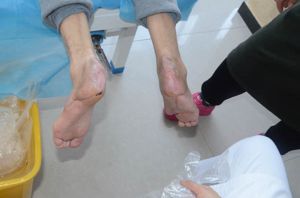 得了糖尿病足要截肢,不截肢有什么后果吗?