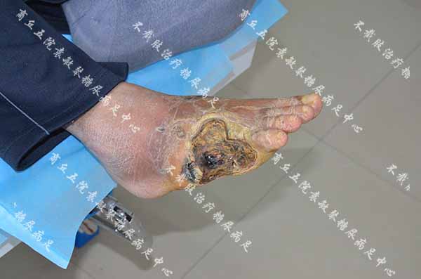 糖尿病足病人特别疼痛,用臭氧缓解治疗真的有用吗?
