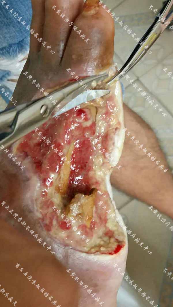 糖尿病足病人特别疼痛,用臭氧缓解治疗真的有用吗?