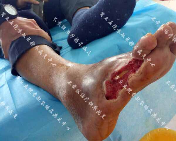糖尿病足病人特别疼痛,用臭氧缓解治疗真的有用吗?