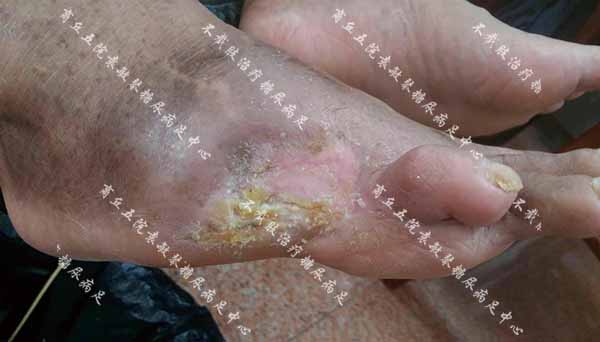 糖尿病足病人特别疼痛,用臭氧缓解治疗真的有用吗?