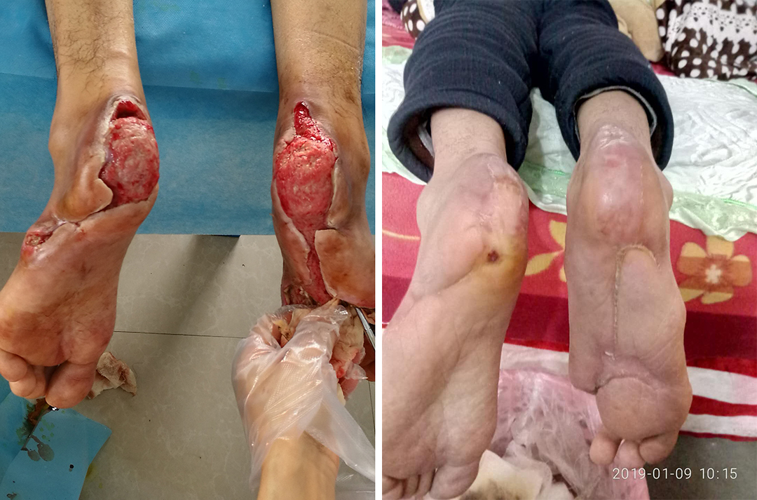 对于糖尿病患者来说,建议大家不要只想着用药涂抹,以免烫伤的伤口加重