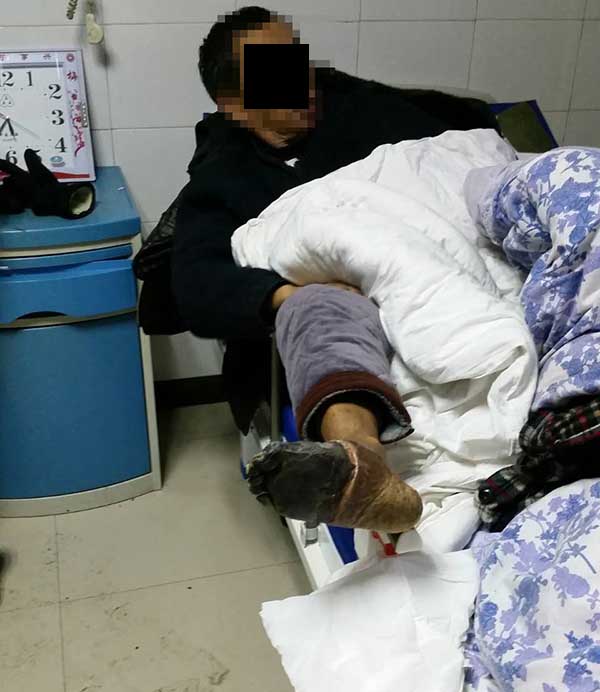 糖尿病人脚趾发黑,怎么治疗才能不截肢呢?