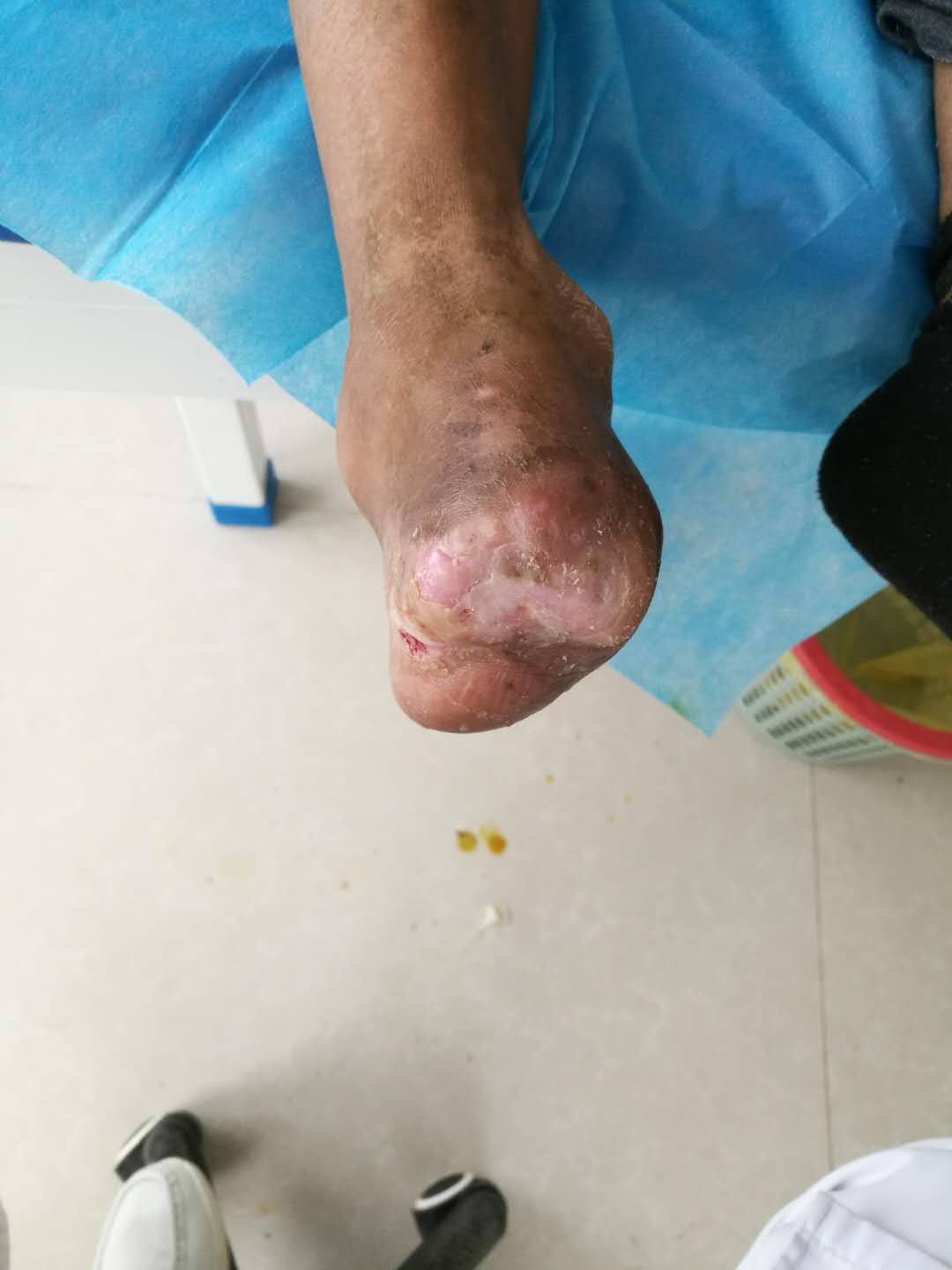 图 上图病人不但脚趾发黑坏死,半个脚掌都坏死了,所有医院都要求膝关节截肢