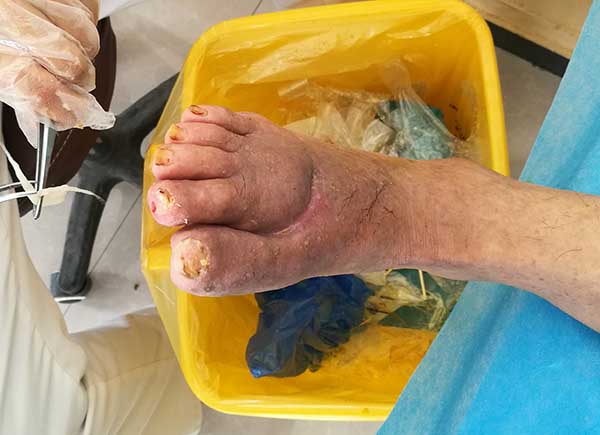 糖尿病人脚上的伤口流脓为什么一直在加重?怎么才能治好?