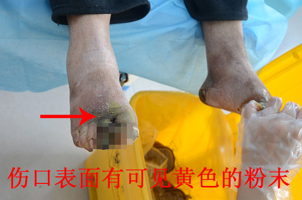 没有治疗糖尿病烂脚的偏方秘方,中西医结合系统治疗可保守不截肢!