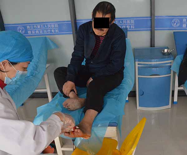 康复案例:云南糖尿病足患者脚趾扩创截趾后伤口感染不愈合的保守治疗