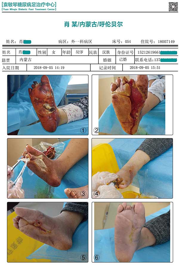 商丘市第五人民医院不截肢保守治疗糖尿病足的案例和图片