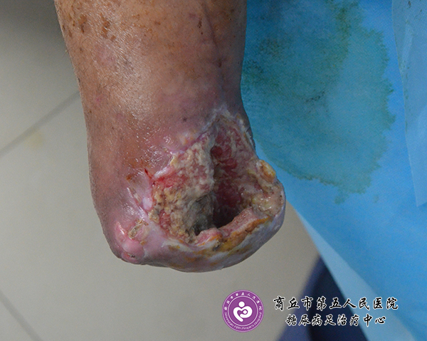 案例：糖尿病人上肢骨折截肢后引起的伤口感染与治疗