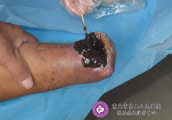 案例：糖尿病人上肢骨折截肢后引起的伤口感染与治疗