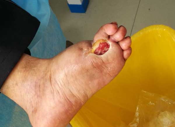 糖尿病足治好后复发率高不高?怎么预防糖尿病烂脚再次复发?