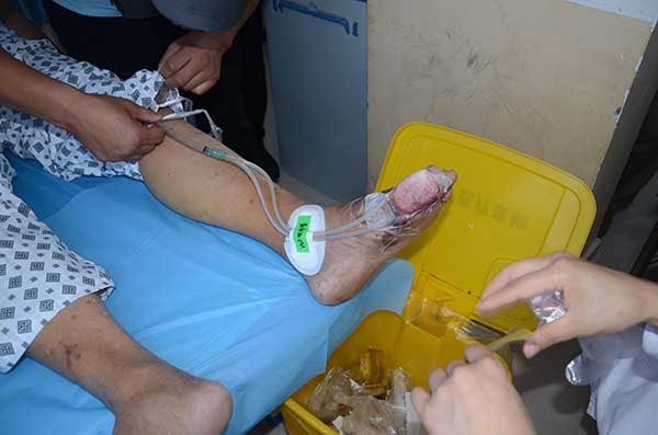 封闭式负压引流技术治疗糖尿病足效果究竟好不好?