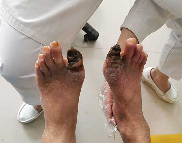 袁敏琴:糖尿病干性坏疽截肢是最好的方法吗?
