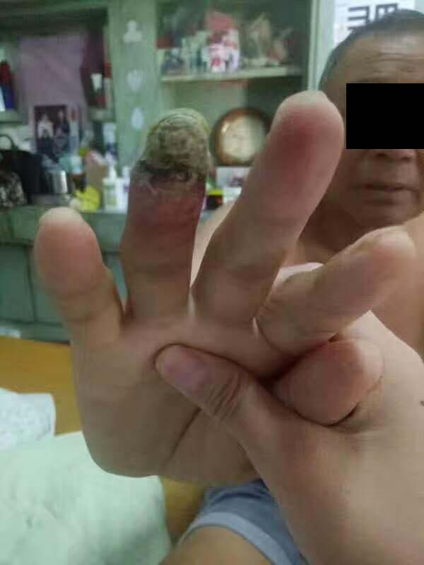 糖尿病引起的手,脚丫烂用什么药抹效果最好?
