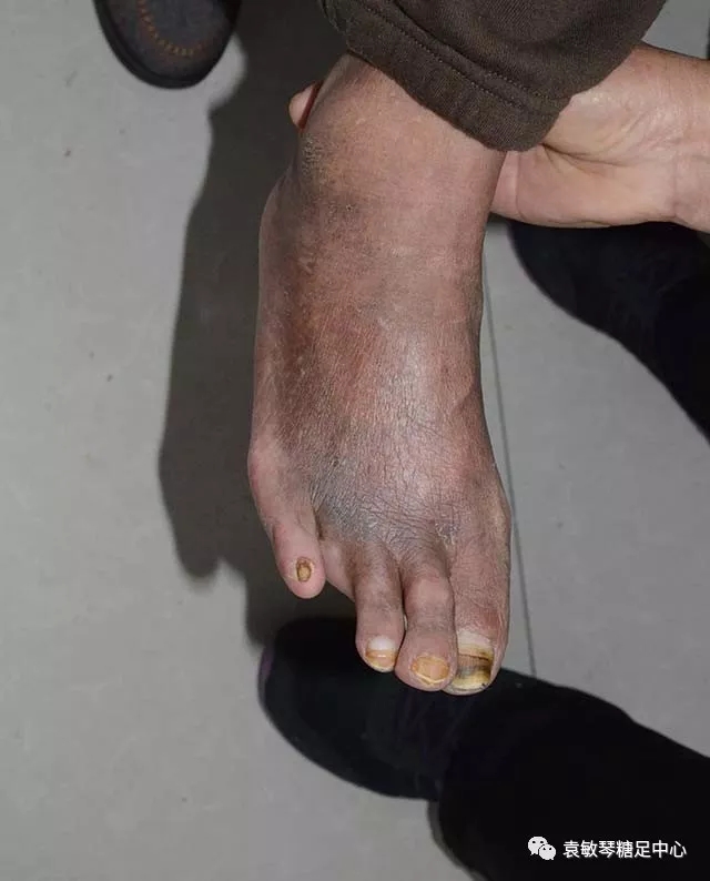 下肢瘫痪,右下肢色素沉着,远端皮下组织硬化,脚踝指凹性肿胀,毛细血管