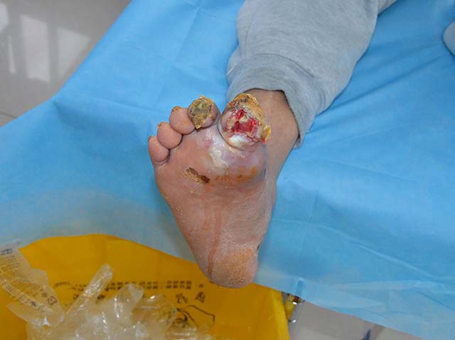 糖尿病脚趾头腐烂症状应该怎么治疗?