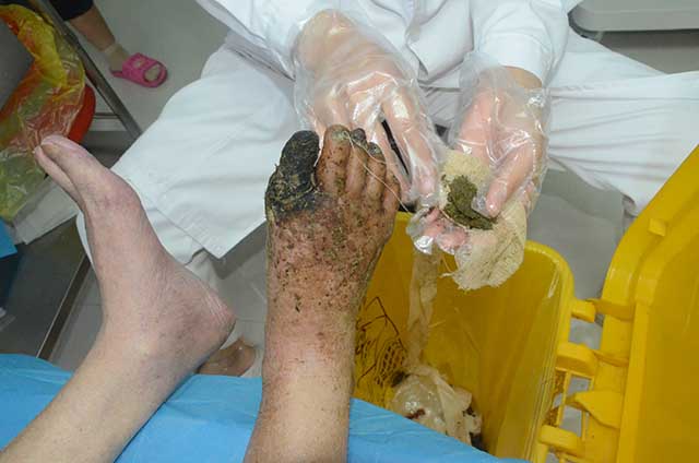 患者的大脚趾完全坏死