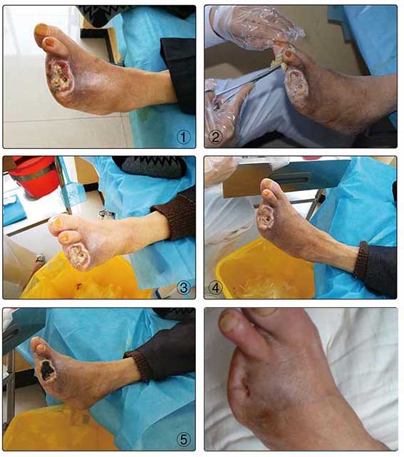 我们往往都是偏重于肾病,忽视了对糖尿病足溃疡的治疗