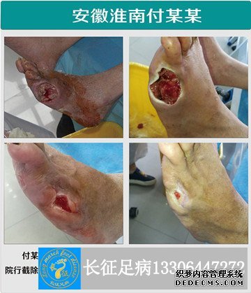 小脚趾截肢_副本.jpg