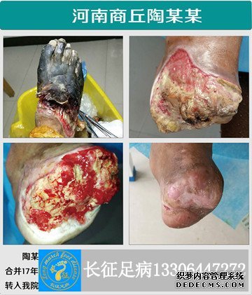 5级干性坏疽_副本.jpg