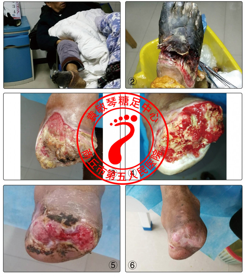 糖尿病足康复病例